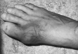Ревматоидный артрит и подагра дифференциальная диагностика thumbnail