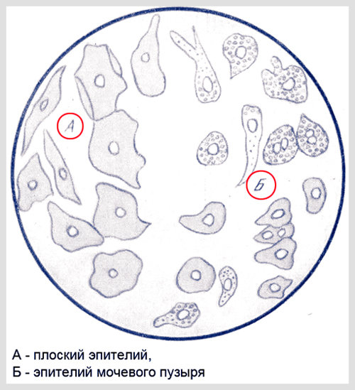Повышенный эпителий в моче у мужчин. Микроскопия мочи эпителий плоский. Микроскопия осадка мочи плоский эпителий норма. Почечный эпителий в осадке мочи под микроскопом. Почечный эпителий в микроскопе.