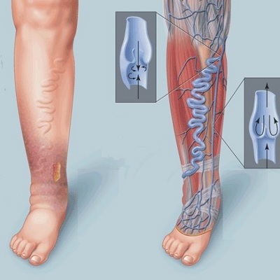Атеросклероз аорты и артерий нижних конечностей