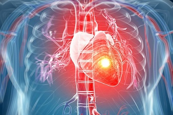Формы инфаркта миокарда клинические рекомендации thumbnail