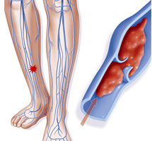 Тромбоз глубоких вен нижних код мкб. Посттромбофлебитический синдром нижних конечностей. Посттромбофлебитический синдром мкб 10. Узелковый полиартериит.