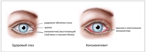 От коньюктивита 3 года. Заболевания вспомогательного аппарата глаза: конъюнктивит. Конъюнктивит симптомы у детей 3.